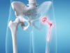 Managing Hip Osteoarthritis in Young Adults